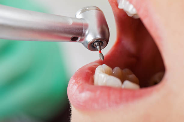 Best Emergency Wisdom Teeth Removal in Gautier, MS